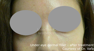 under eye dermal filler after Mendham Larchmont